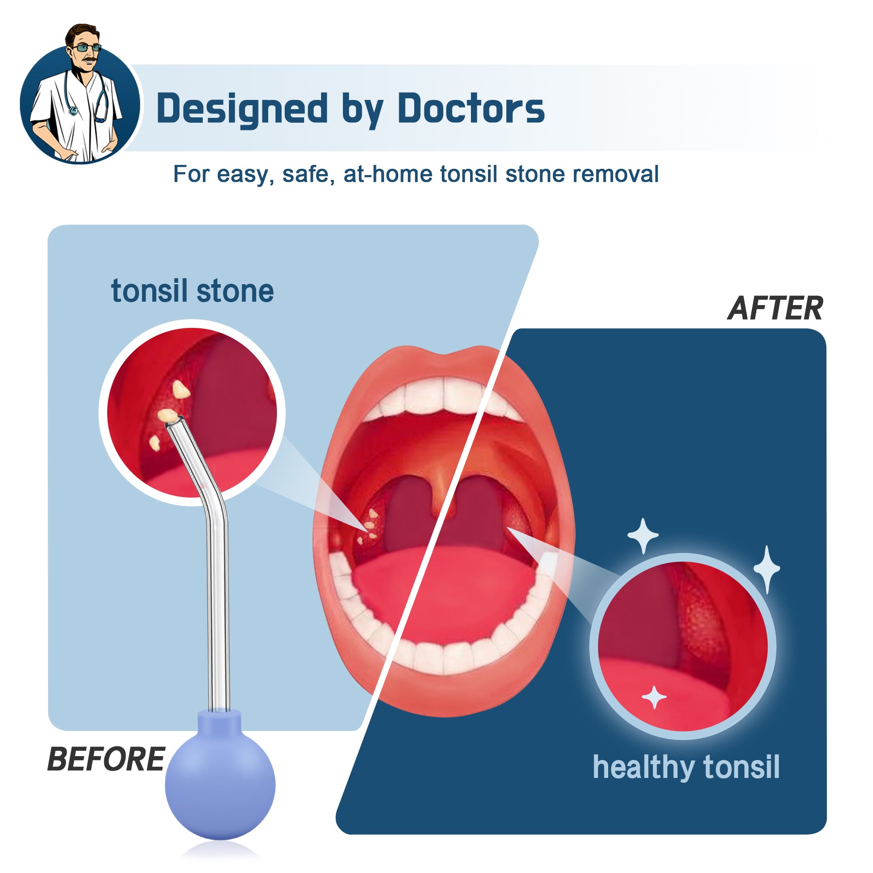 Tonsil Stone Remover Vacuum Tonsil Stone Removal Kit Tonsil Stone Cupping Tool